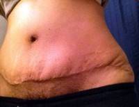 Tummy tuck and weight gain scar