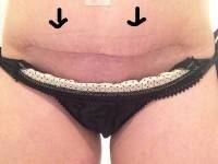 Tummy tuck expectations image after