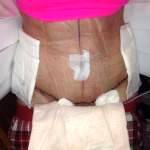 Tummy tuck loose skin before and after gallery