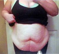 Tummy tuck loose skin before and after photo