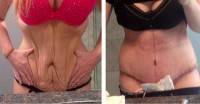 Tummy tuck loose skin before and after surgery