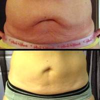 Tummy tuck lose weight picture