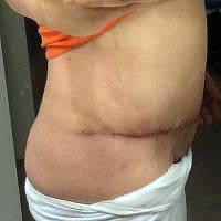 Tummy tuck low scar photo