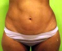 Tummy tuck on skinny person image
