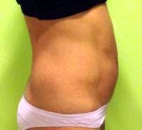 Tummy tuck on skinny person photo before