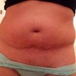 Tummy tuck operation after pregnancy pictures