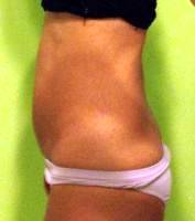 Tummy tuck operation before and after weight loss