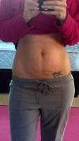 Tummy tuck operation to lose weight