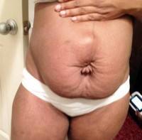 Tummy tuck operation without muscle repair