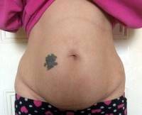 Tummy tuck operation without muscle tightening