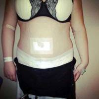 Tummy tuck pain pump after surgery
