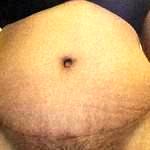 Tummy tuck patients after pregnancy pictures