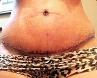 Tummy tuck recovery time image