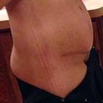 Tummy tuck scar after pregnancy pictures