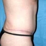 Tummy tuck scar images gallery