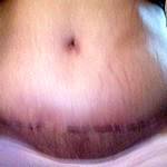 Tummy tuck scar images gallery pictures