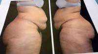Tummy tuck surgery after major weight loss