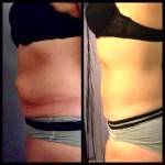 Tummy tuck surgery loose skin before and after