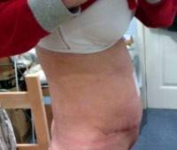 Tummy tuck surgery scar healing process