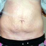 Tummy tuck surgery scar images