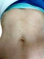 Tummy tuck surgery skin removal