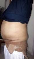 Tummy tuck surgery without drain tubes