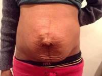 Tummy tuck surgery without muscle repair