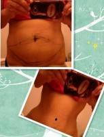 Tummy tuck to lose weight before and after