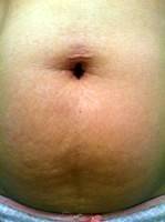 Tummy tuck types picture