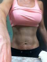 Tummy tuck with stretch marks photo before