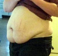 Tummy tuck without muscle repair photo before