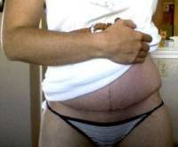 Vertical tummy tuck picture