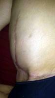 Vertical tummy tuck scar photo