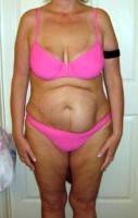 Weight loss tummy tuck surgery before and after