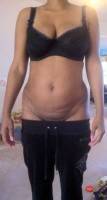 What is a full tummy tuck operation