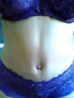 What is a mini tummy tuck image