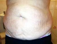 What is a tummy tuck procedure images