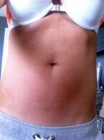 belly for Successful tummy tuck