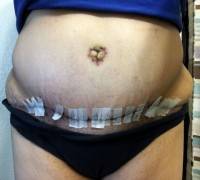 A tummy tuck photo after