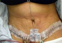 A tummy tuck photo recovery strips