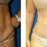 A tummy tuck pictures before and after