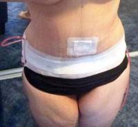 A tummy tuck recovery after surgery