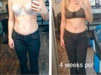 A tummy tuck results before and after photo