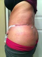 A tummy tuck scar after surgery
