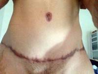 Abdominal plastic surgery scar