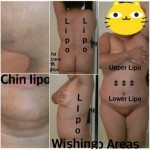 Abdominoplasty Tummy tuck before and after pics
