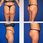 Abdominoplasty Tummy tuck pictures before and after