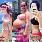 Abdominoplasty pictures before and after