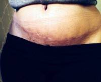 Abdominoplasty scar and hernia repair