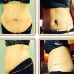 Abdominoplasty scars pictures before and after